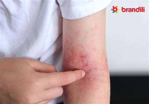 Alergia Ao Calor Fotos - Alergia ao calor: o que é, sintomas, causas e prevenção