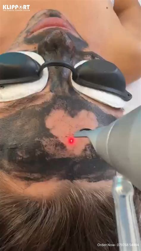 KLIPPORT | 🎥 Glow Up with KLIPPORT's Carbon Peel Q-Switch Laser Machine