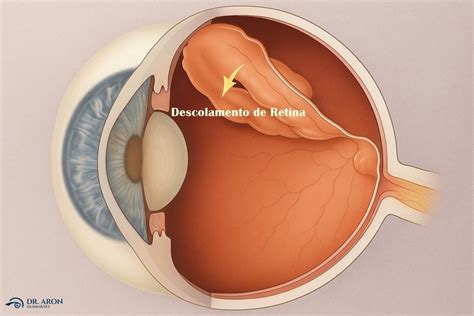 O Que E Deslocamento De Retina - Cirurgia de Retina