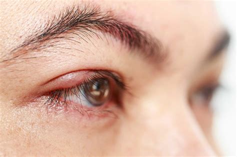 Stye in the eye - Metropol