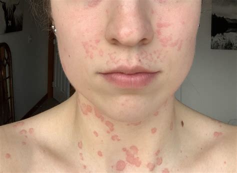 Urticarial Vasculitis Face
