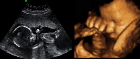 Best time for 3D/4D ultrasound- baby gender- Boardman Ohio