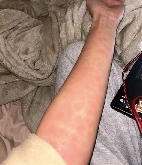 New meds made me break out into hives : r/Wellthatsucks