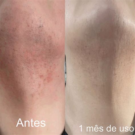 Açafrão No Rosto Antes E Depois - Sabonete de açafrão - depilação natural, sem foliculite e manchas