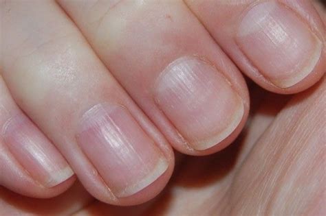 Ridged nails? Here’s why – and how to treat them – Scratch