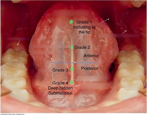 dr kim discussions understand  tongue tie diagnosis