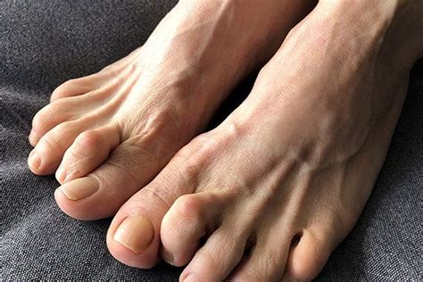 Claw Toe: Causes, Symptoms and Effective Podiatric Treatment