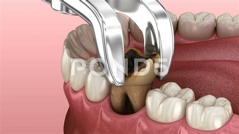 pulling  molar tooth