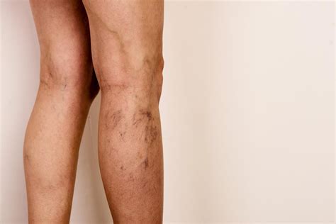 What Causes Varicose Veins (Varicosities) in the Legs?