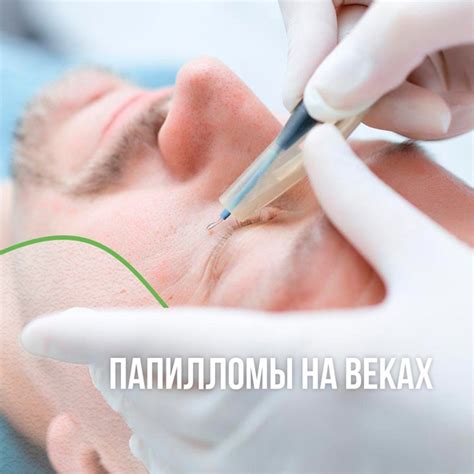 Удаление папиллом в области верхнего века методом электрокоагуляции ...