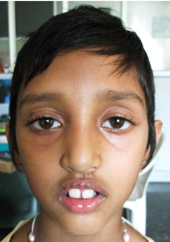 Adenoid Facies