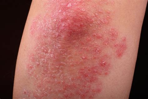 Pediatric psoriasis comorbidity screening guidelines address children’s ...