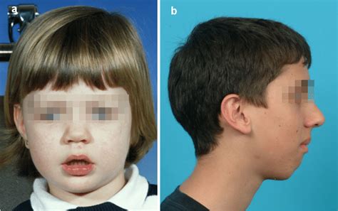 Long Face Syndrome