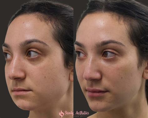 Chin Fillers - Before & After Results at Skinly