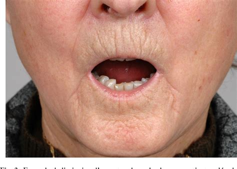 Systemic Scleroderma Face