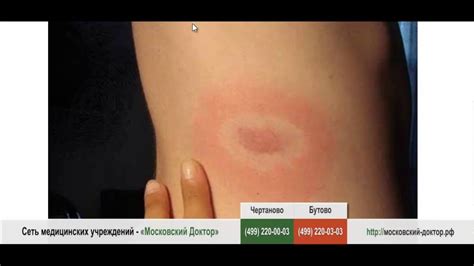 Аллергия на укус клеща - YouTube
