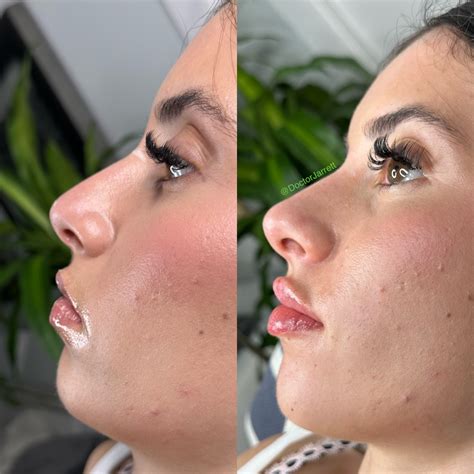 Nonsurgical Rhinoplasty - Designer Aesthetics by Dr. Jarrett Schanzer