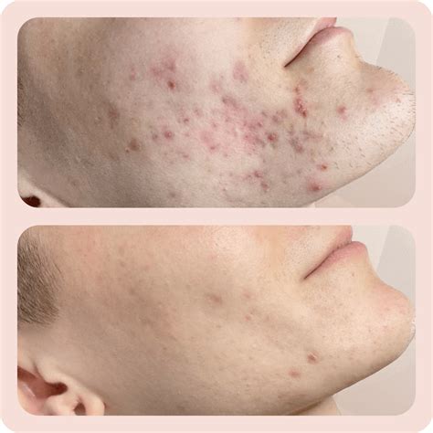 Peeling - Trajtimi Peeling për fytyrën - Klinika DaVINCI