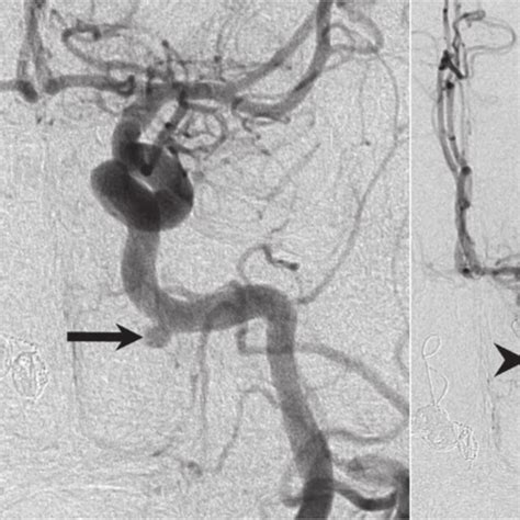 Celiac artery angiogram revealed a normal variation of the vessel ...