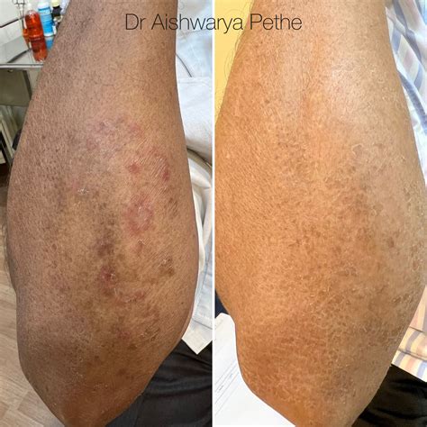 Clearance of Fungal infection aka Tinea corporis after treatment