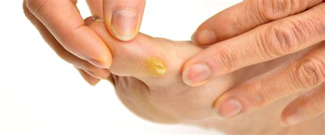 treat calluses  remove