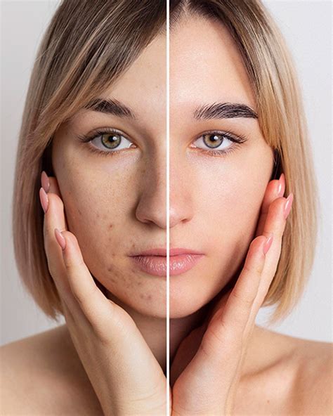 laser acne spot removal treatment   price  dhaka