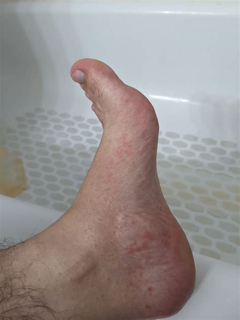 29 M, Intensely itchy red bumps on feet. Started yesterday and got