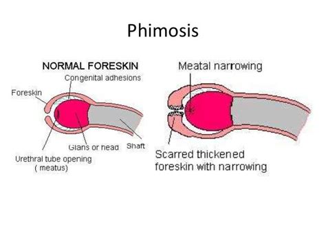 Is Phimosis Really That Bad? , Five Levels of Phimosis severity – QRJMN