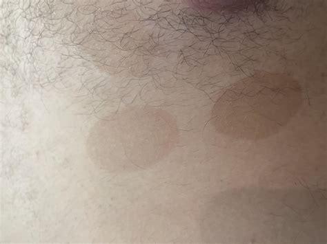 Itchy Lump On Chest Male at Savannah Cawthorne blog