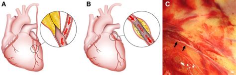 chronic total occlusion  treated  coronary artery bypass