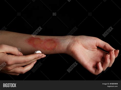 Treatment Burns On Image & Photo (Free Trial) | Bigstock