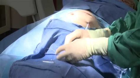 PD Percutaneous Implantation Video - YouTube