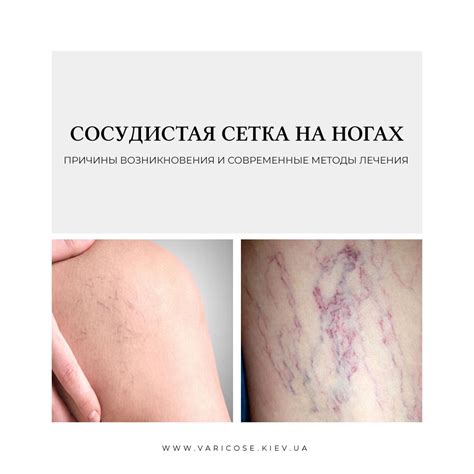 Сосудистая сетка на ногах: причины возникновения и современные методы ...