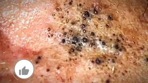 Experts Warn: This Unbelievable Blackhead Removal 2024 Trend is Dangerous! - yr3y5rr