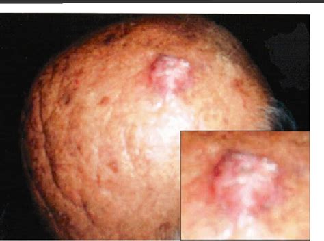 Figure 1 from Inverted Follicular Keratosis Scalp | Semantic Scholar