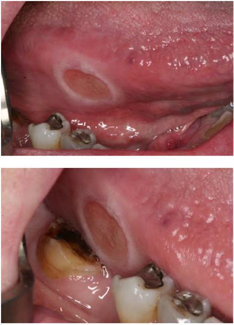 Inflammatory And Reactive Lesions Of The Oral Mucosa Red Lesions of the