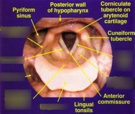 epiglottis real picture diagram quizlet