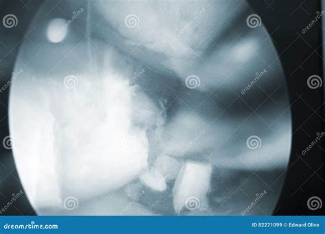 Arthroscopy surgery screen stock image. Image of intervention - 82271099