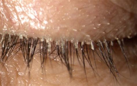 Saca la aseguranza Oscurecer Cerveza demodex en los ojos deseable ...
