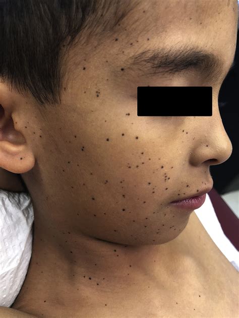 A case of eruptive melanocytic nevi in an 8-year-old healthy boy - JAAD