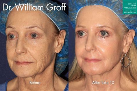 treatment  deep facial wrinkles cosmetic laser