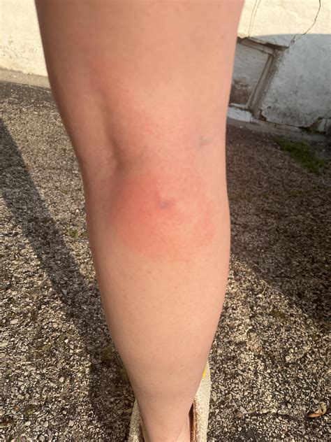 brown recluse bite. full body rash. : r/BrownRecluseBites