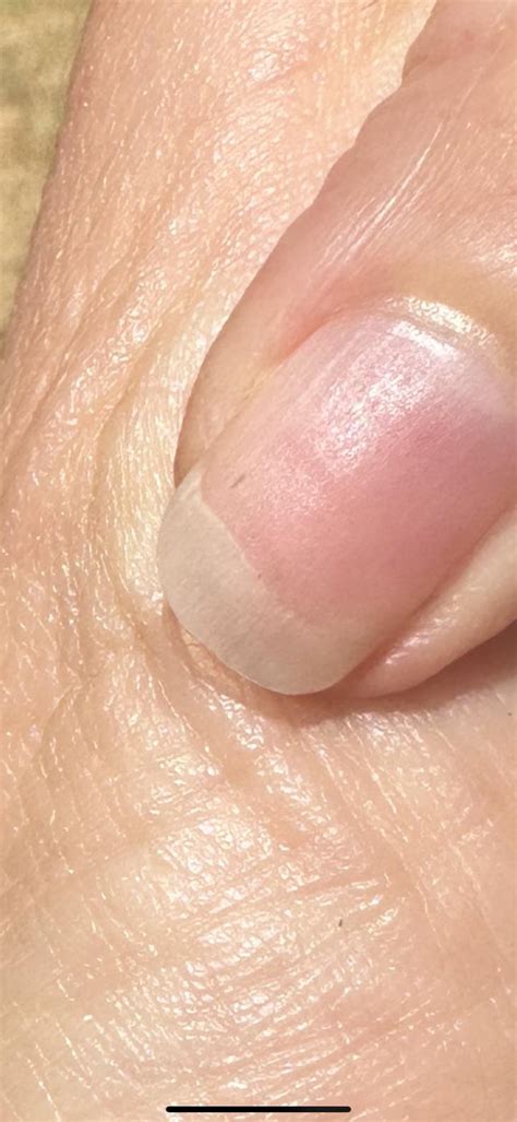 Nail splinter hemorrhages : r/Raynauds