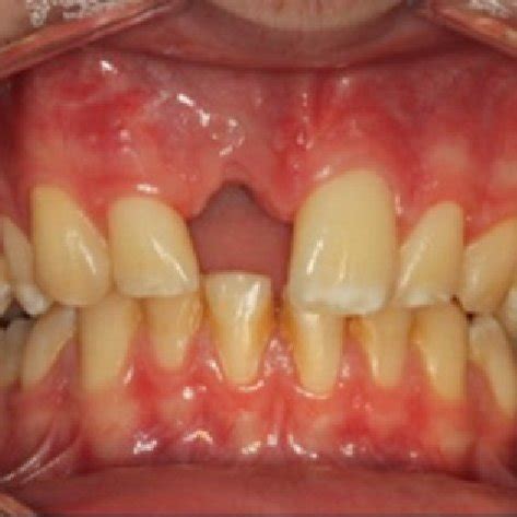 harvested ramus bone block graft  splitted horizontally
