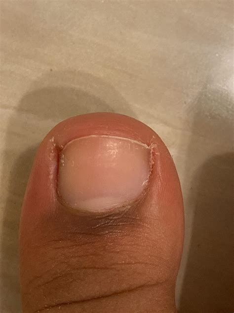 Is this an ingrown nail?? my big toes been hurting a lot lately and i