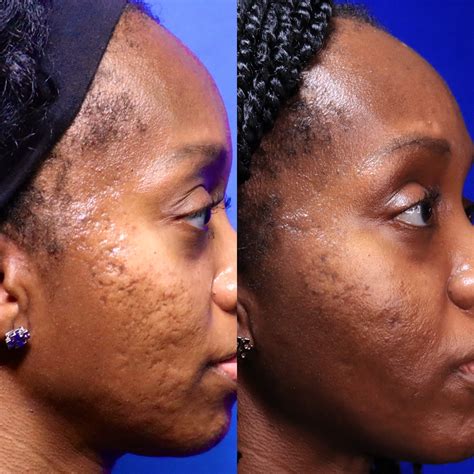 Acne Scars And Treatment at Lloyd Sutton blog