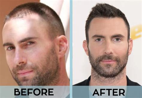 31 Celebrities With Hair Transplant | Before & After Photos