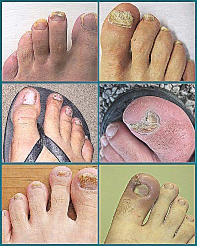 Does Vicks VapoRub for Toenail Fungus Really Work? - Healthy Lifestyle