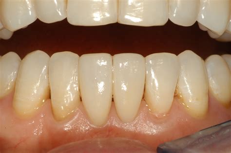 Lower Anterior Teeth