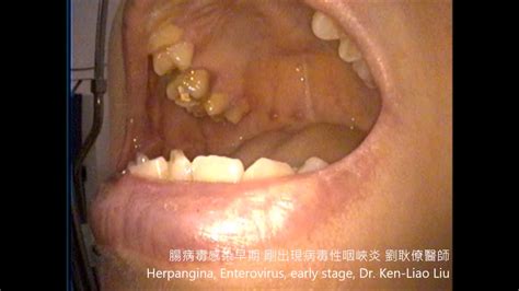 herpangina enterovirus youtube
